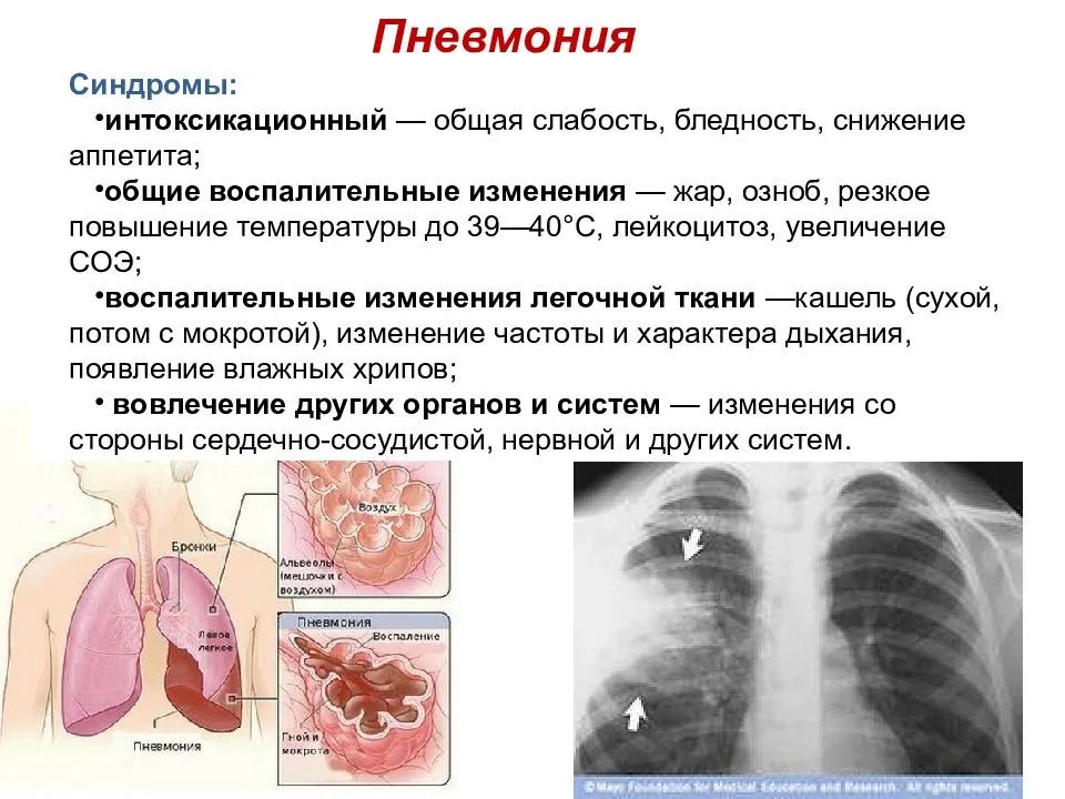 Пневмония легких опасно. Заболевания органов дыхания. Забооеванияорганов дыхания. Сообщение о заболеваниях органов дыхания. Заболевания органов дыхательных путей.